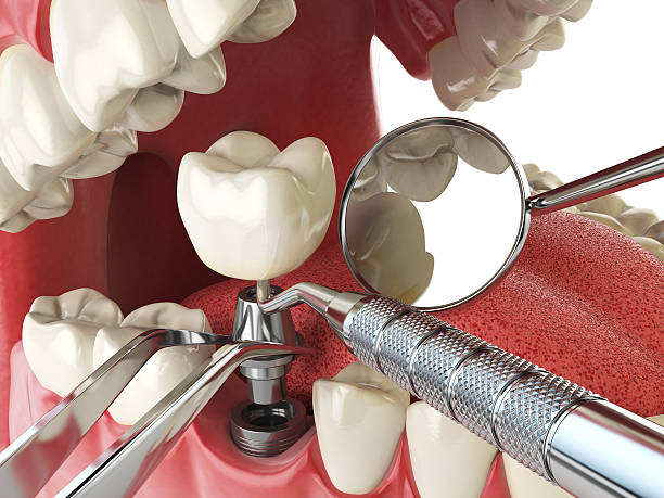 Best Emergency Root Canal Treatment in Avondale, LA